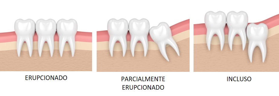 Dentes do siso