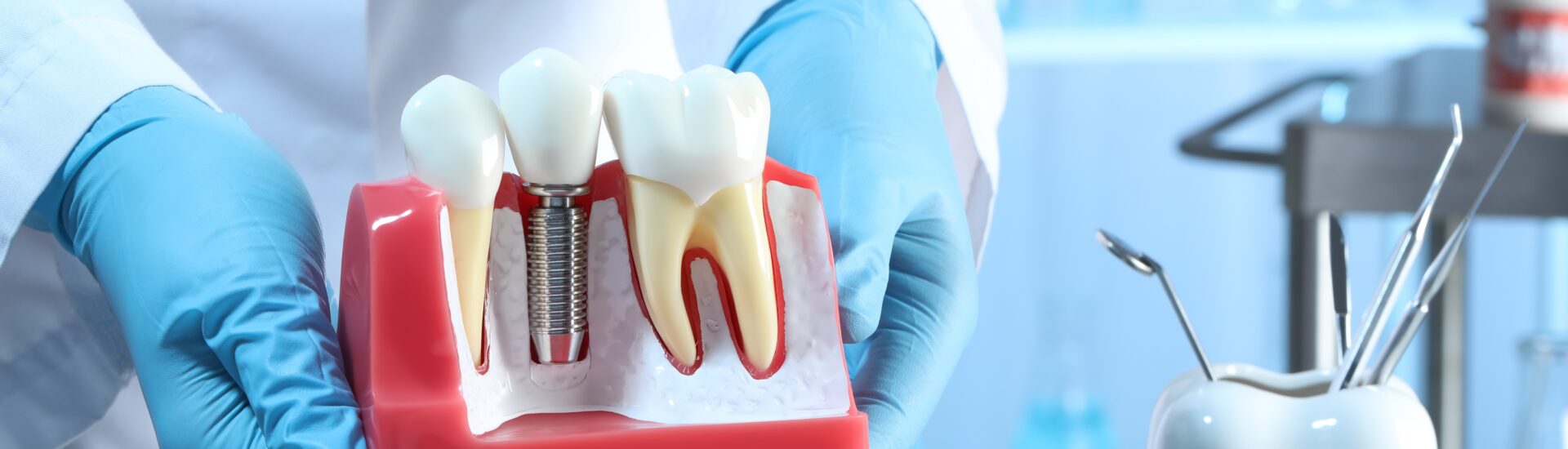 implantes dentários: conhecimentos