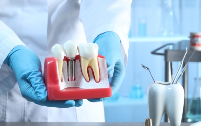 Teste os seus conhecimentos sobre implantes dentários