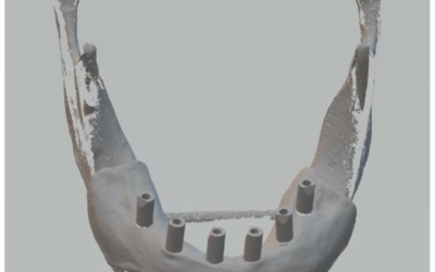 Accuracy of Extraoral Digital Impressions with Multi-Unit Implants